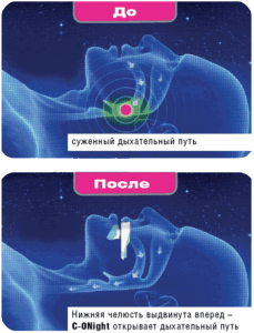 Устройство от храпа C-ONight Устройство от храпа C-ONight
